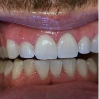 Porcelain Veneers Makeover